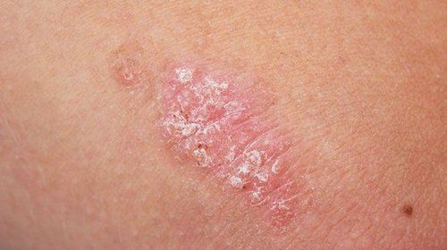 Bệnh vẩy nến là một trong các bệnh tự miễn