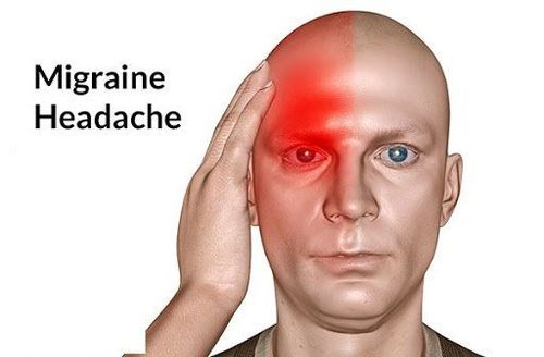 Đau đầu kiểu Migraine