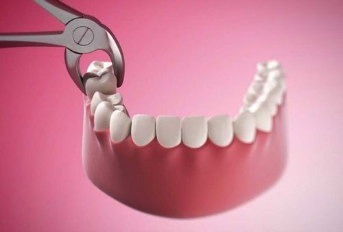 Nhổ răng khôn giúp tạo khoảng trống cho răng hàm di chuyển