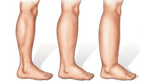 Lymphedema causes swelling in the patient’s legs or arms  
