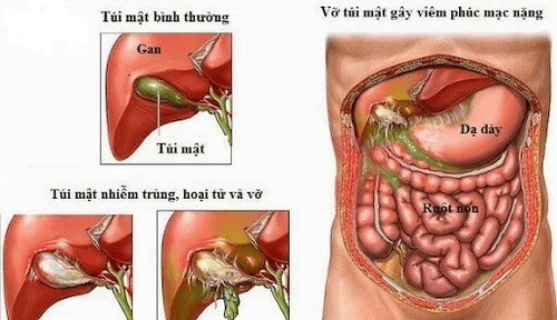 Viêm phúc mạc mật cần phẫu thuật cấp cứu