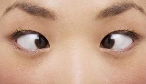 
Có thể khẳng định liệt dây thần kinh số 6 là 1 rối loạn có ảnh hưởng tới chức năng vận động của mắt
