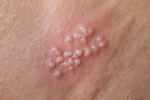 Molluscum contagiosum appears on every areas of the body