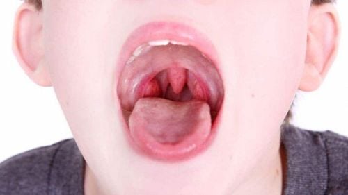 Is it dangerous to have a swollen throat and swollen lymph nodes in the neck and tongue?