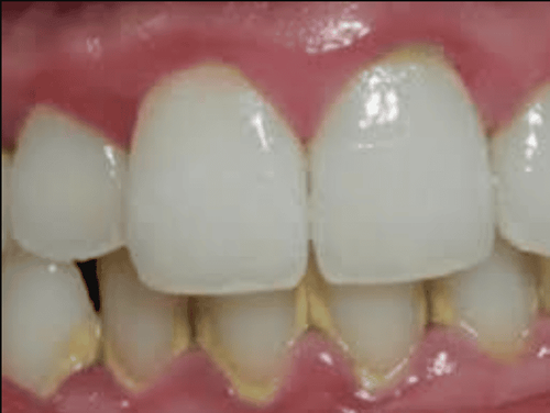 Cao răng hay còn được gọi là vôi răng là những mảng bám được tích tụ và bị vôi hóa bởi các hợp chất muối vô cơ trong nước bọt và cặn mềm