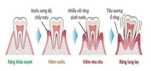 Các bệnh lý của vùng quanh răng