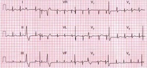 Along with premature atrial contractions, premature ventricular contractions are a type of premature contractions.
