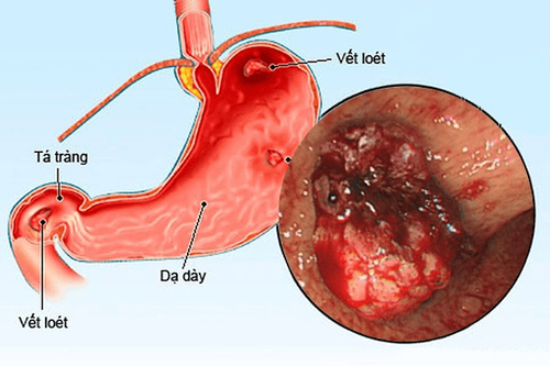 Bệnh nhân bị viêm loét dạ dày nên bổ sung thảo quả