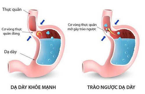 Sau khi gây mê nội khí quản có thể bị trào ngược dịch dạ dày