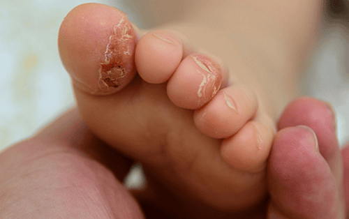 
Bệnh vảy nến ở trẻ sơ sinh gây nhiều biến chứng nguy hiểm
