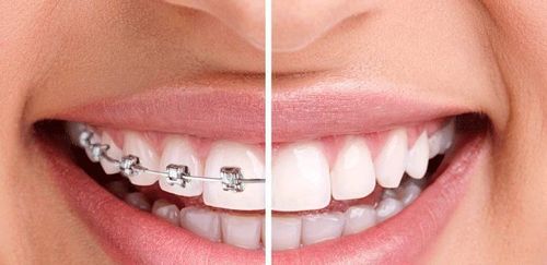 Thời gian chỉnh nha cho người lớn tùy thuộc vào tình hình răng cụ thể