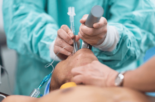 Hình ảnh quy trình gây mê đặt nội khí quản đường miệng
