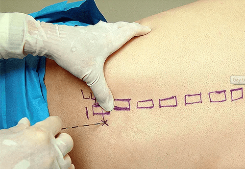 Gây tê tủy sống có thể được thực hiện vào đường giữa hoặc đường bên
