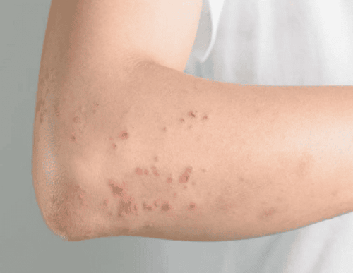 Bệnh giun đũa (Ascaris lumbricoides) là nguyên nhân thường gặp nhất gây ra hội chứng Loeffler