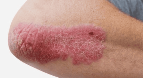 Gel nha đam có thể có hiệu quả trong điều trị bệnh vảy nến