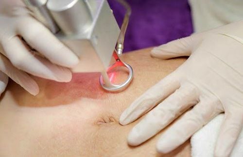 A doctor uses a CO2 laser to treat stretch marks

