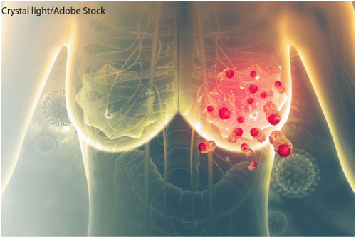 Patients with breast cancer should increase their intake of taro root
