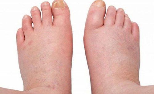
Phù nề chân ,tay là một trong số triệu chứng của Bệnh suy thận mạn tính
