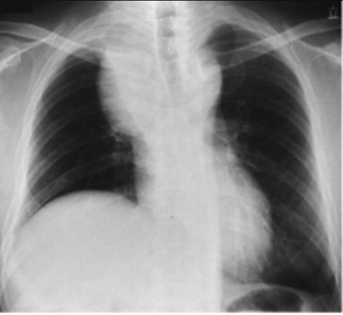 Hình ảnh thùy trên phải bị xẹp do adenocarcinoma (ung thư biểu mô tuyến) mọc từ phế quản thùy trên