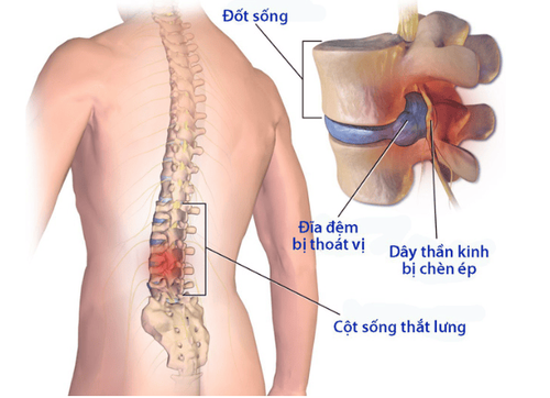 Thoát vị đĩa đệm cột sống thắt lưng có thể xảy ra do chấn thương