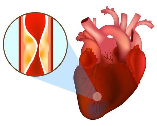Rung nhĩ có thể gây ra biến chứng nhồi máu cơ tim
