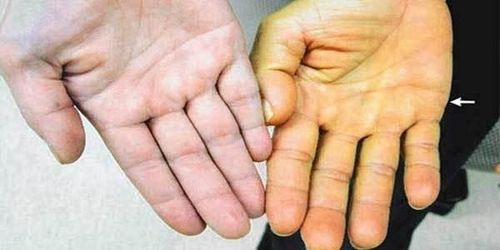 Vàng da là một trong những biểu hiện của bệnh chai gan