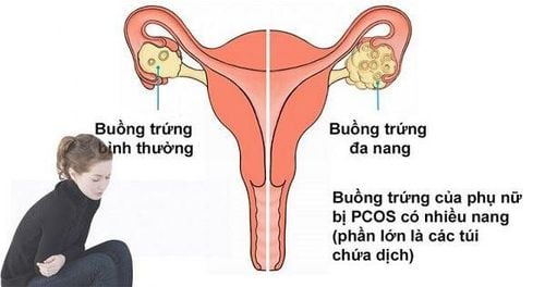 
Hội chứng buồng trứng đa nang là nguyên nhân gây sảy thai
