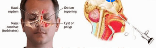 Các bước thực hiện chọc rửa, thông xoang hàm