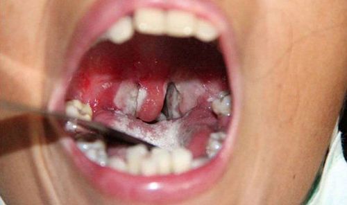 Bạch hầu họng là bệnh lý không thể chủ quan