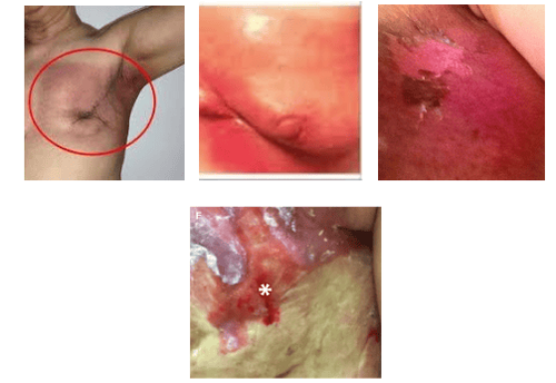 Minh họa phân độ viêm da xạ trị: Độ 1, 2, 3, 4 theo thứ tự từ trái qua phải.