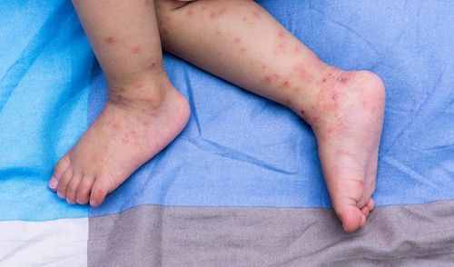 Nhấn vào ảnh để phóng to
Bệnh tay chân miệng do virus đường ruột gây ra