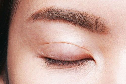 What is the effect of removing excess fat from the upper eyelids?