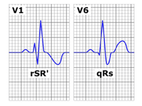 Understanding Right Bundle Branch Block