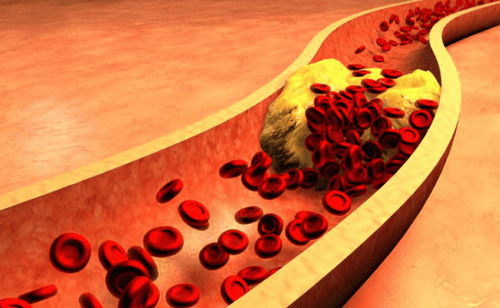 High blood cholesterol is considered a cause of diabetes.
