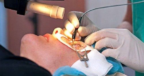 Phẫu thuật mắt có thể được thực hiện nếu các phương pháp khác không đem lại hiệu quả
