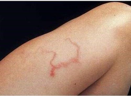 Phần lớn những người bị nhiễm giun lươn là không có triệu chứng