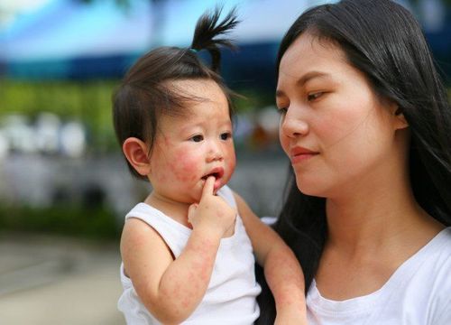 Loét miệng, phát ban dạng phỏng nước, sốt nhẹ là những dấu hiệu điển hình của bệnh tay chân miệng