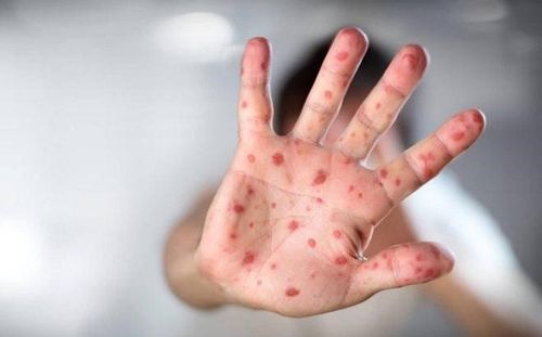 Tay chân miệng là bệnh truyền nhiễm do các chủng virus đường ruột gây ra, có thể lây trực tiếp từ người sang người