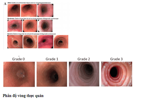 Hình ảnh các vòng tròn đồng tâm trên nội soi của VTQBCAT và phân độ theo thang điểm EREFS (Endoscopic Reference Score): độ 0: các vòng tròn đồng tâm không rõ, độ 3: có rất nhiều vòng tòn đồng tâm dọc theo chiều dài thực quản (Nguồn ảnh: researchgate.net)