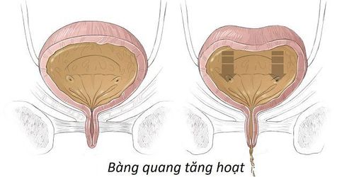 Hội chứng bàng quang tăng hoạt là một bệnh thường gặp, xảy ra khi bàng quang có sự co thắt đột ngột mà không có sự kiểm soát và khi bàng quang không chứa đầy nước tiểu