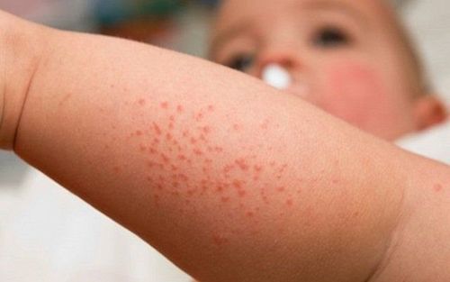 Trẻ bị mẩn ngứa do nhiều nguyên nhân chứ không riêng vấn đề về gan