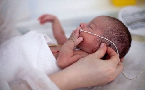 Trẻ sinh non rất dễ bị chứng trào ngược dạ dày