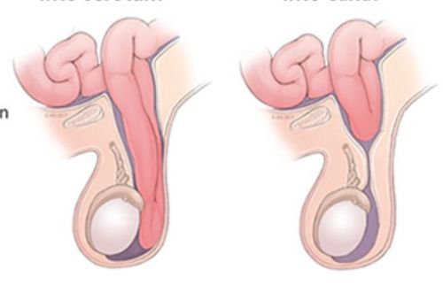Inguinal hernia can be a cause of testicular swelling in children.
