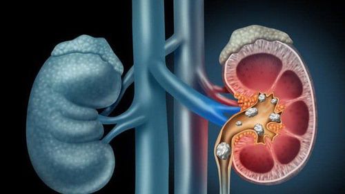 Cặn thận có điều trị dứt điểm được không?