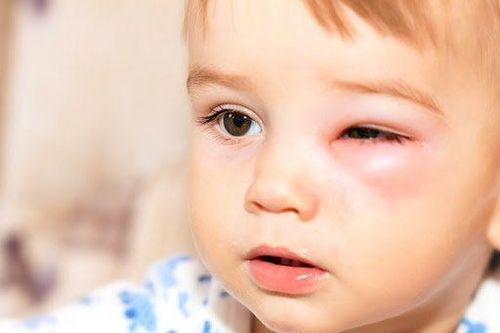 Viêm mô tế bào ở gần ổ mắt gây ra tình trạng các vòng đỏ quanh mắt