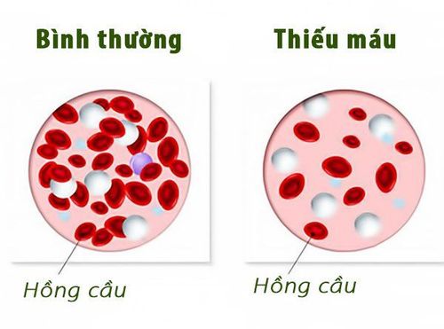Anemia affects patients’ quality of life