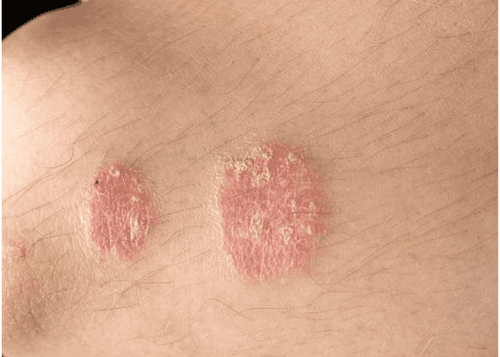Psoriasis in Crohn's Disease