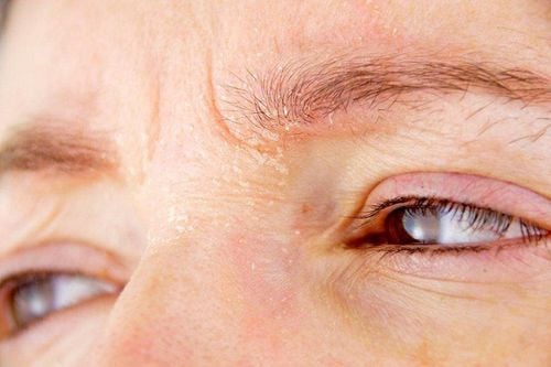 Why do you have red rings around your eyes?