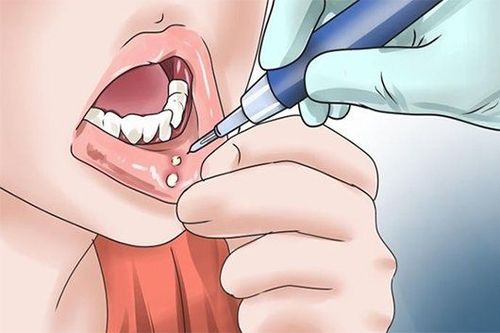 Người cao tuổi tăng nguy cơ mắc bệnh ung thư miệng