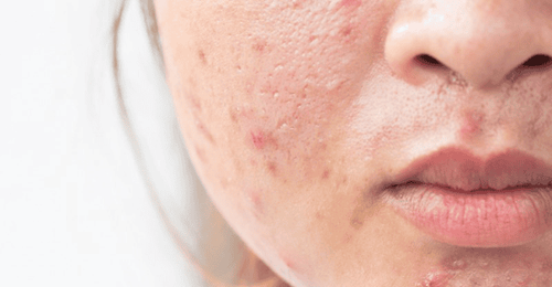 Some dermatologists also recommend using tretinoin to treat acne scars.